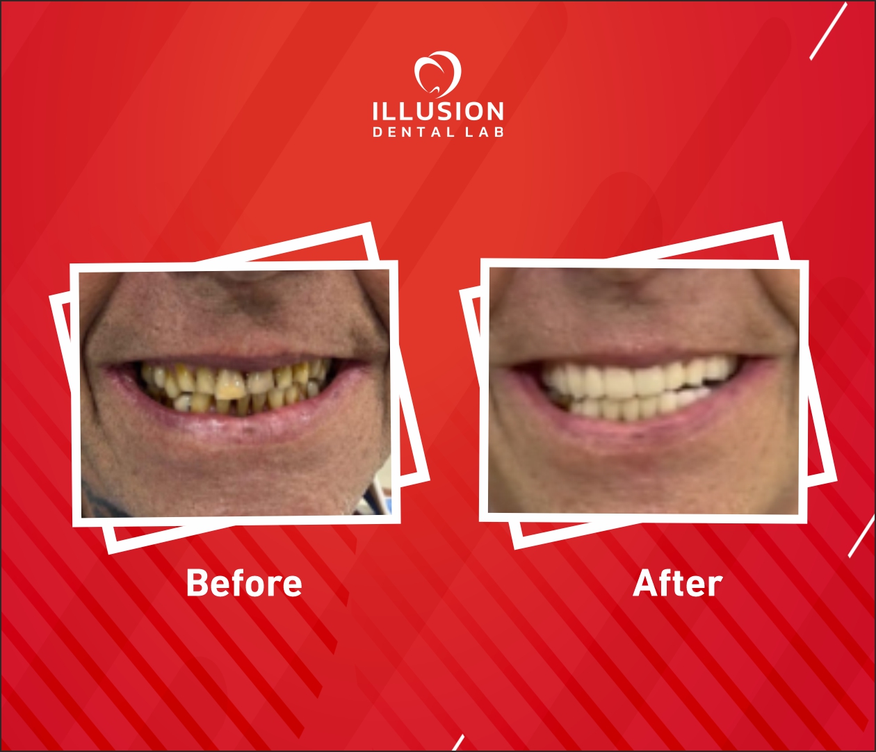 FMR using All-on-6 Implants with Zirconia Dental Crowns